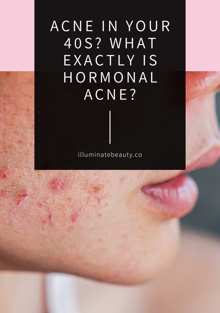 Acne in your 40s? What exactly is Hormonal Acne?