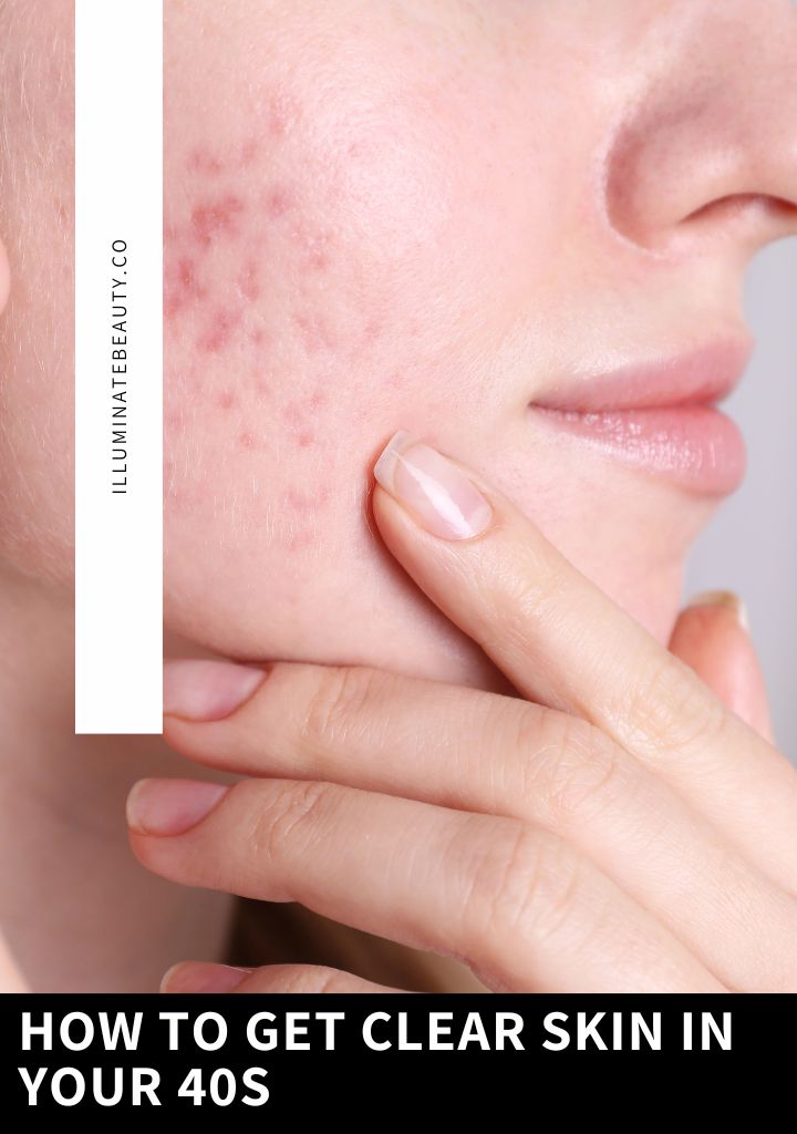 Acne in your 40s? What exactly is Hormonal Acne?